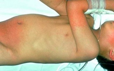 Trẻ em Nhật Bản mắc bệnh  nghi do gió độc từ Trung Quốc?